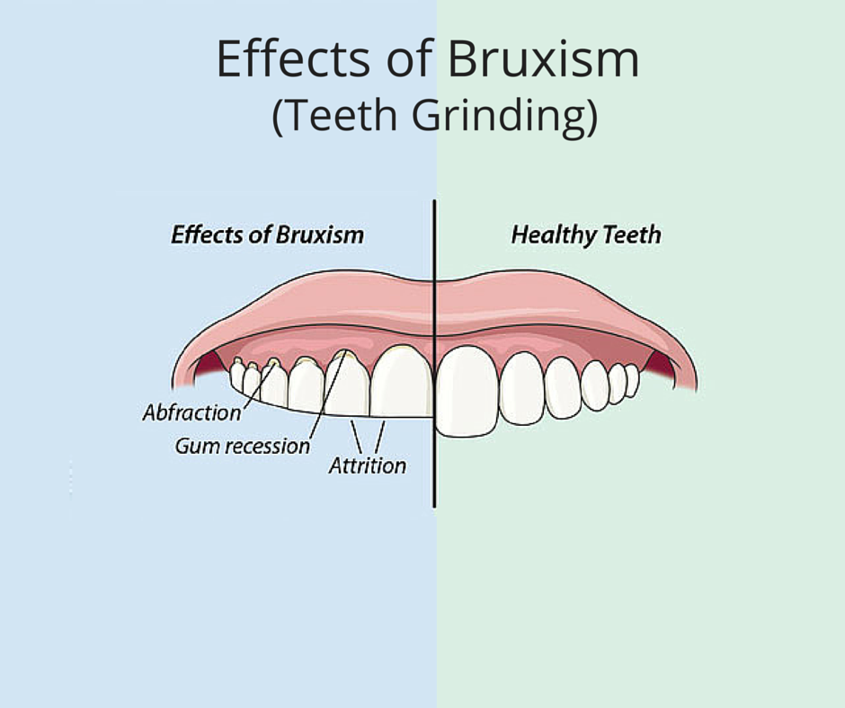 4 things you didn’t know about Bruxism - AKA - Grinding, Clenching, Clacking or Gnawing
