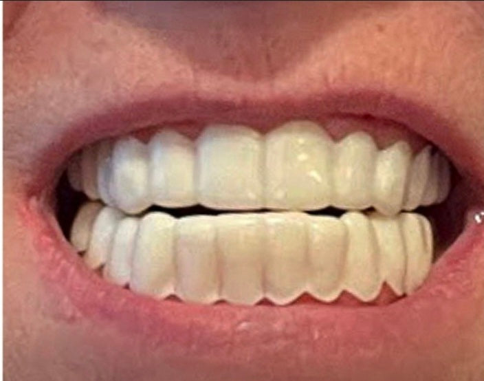 Veneers